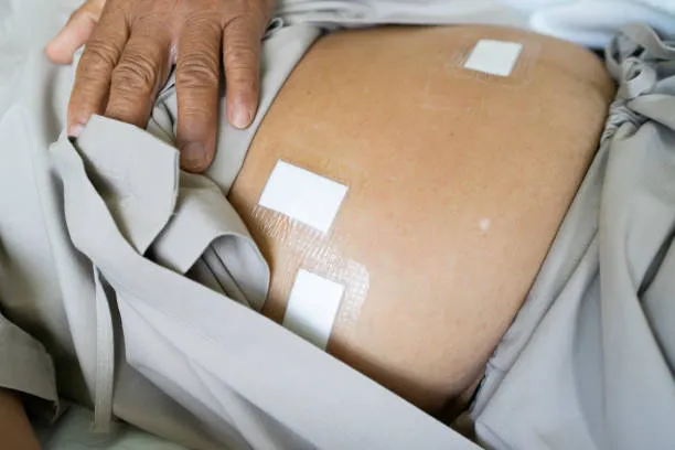 Laparoscopia avanzada